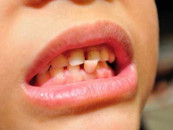 4 Cara Mengatasi Gigi Goyang dengan Bahan Alami